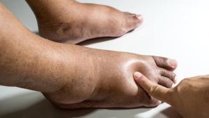Kaki Bengkak Gara-Gara Diabetes, Berikut 10 tips Mengatasinya