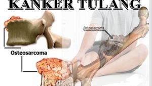 Pentingnya Deteksi Dini Kanker Tulang Diungkap Pakar ortopedi