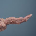 Meredakan Gejala Osteoporosis Pada Lansia