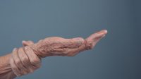 Meredakan Gejala Osteoporosis Pada Lansia