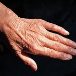 Lansia Rentan Terkena Xerosis