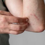 Lansia Lebih Rentan Terhadap Actinic Keratosis