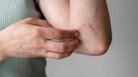Alasan Mengapa Lansia Lebih Rentan Terhadap Actinic Keratosis