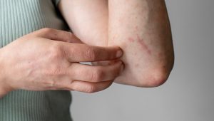 Alasan Mengapa Lansia Lebih Rentan Terhadap Actinic Keratosis