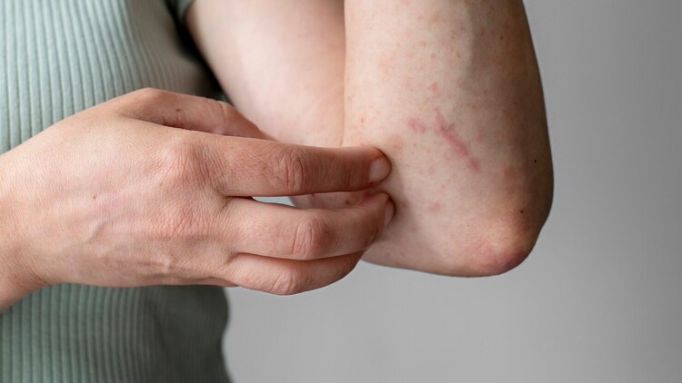 Lansia Lebih Rentan Terhadap Actinic Keratosis