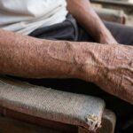 Merawat kulit kering dan gatal pada lansia