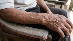 Merawat Kulit Kering dan Gatal pada Lansia agar Tetap Sehat dan Nyaman